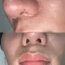 鼻翼基部形成（貴族手術） HAAB BEAUTY CLINIC 名古屋院 AFTER サムネイル用