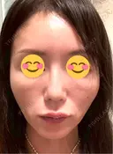 ピコレーザートーニング（美白・肝斑） シェリークリニック 渋谷院 DAY 3 サムネイル用