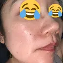イオン導入 / レーザートーニング（美白・肝斑） Kinshicho Beauty Clinic （錦糸町ビューティークリニック） AFTER サムネイル用