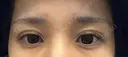 ボトックス（あご） / ボトックス（エラ・小顔） / ボトックス（口角） / ボトックス（眉間） Belle Via Skin Clinic DAY 0 サムネイル用