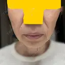 その他（肌） / RF（高周波）たるみ治療 ルラ美容クリニック 札幌本院 DAY 12 サムネイル用