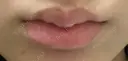 ヒアルロン酸注入（唇） 目白ホワイトクリニック DAY 9 サムネイル用