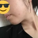 ボトックス（エラ・小顔） 東京シルククリニック 新宿院 DAY 2 サムネイル用