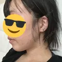 ボトックス（エラ・小顔） 東京シルククリニック 新宿院 DAY 2 サムネイル用