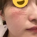 小鼻縮小（非切開） / 肌育注射（ジュベルックなど） 吉祥寺アイビークリニック DAY 0 サムネイル用