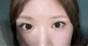 二重埋没 / 目頭切開 アリエル美容クリニック 大宮院 DAY 29 サムネイル用