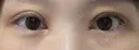二重切開 / 目頭切開 / 眼瞼下垂（切開） EMMA CLINIC（エマクリニック） DAY 31 サムネイル用
