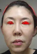 白玉点滴・注射 城本クリニック 大阪院 DAY -2 サムネイル用