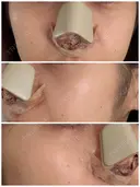 隆鼻術 / 鼻尖形成（切開） / 鼻中隔延長（切開） / その他（鼻） / 軟骨移植 / 鼻翼基部形成（貴族手術） / 鼻柱下降・鼻唇角形成（猫手術） WOM CLINIC GINZA （ワム クリニック ギンザ） DAY 9 サムネイル用