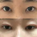 二重切開 表参道スキンクリニック 表参道院 DAY 98 サムネイル用