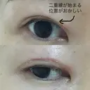 二重切開 表参道スキンクリニック 表参道院 DAY 98 サムネイル用