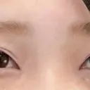 目頭切開 ネビュラクリニック 京都院 AFTER サムネイル用