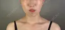 糸リフト / バッカルファット除去 / 脂肪吸引（顔） / ジョールファット除去 / ボトックス（エラ・小顔） アリエル美容クリニック 郡山院 DAY 93 サムネイル用
