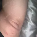 ワキ汗治療（レーザー） ゆう美容クリニック AFTER サムネイル用