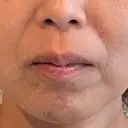 ハイフ（顔） ARTE BEAUTY CLINIC AFTER サムネイル用
