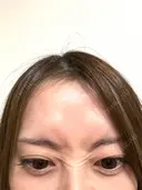 ボトックス（額） 大美会クリニック 京都烏丸院 AFTER サムネイル用