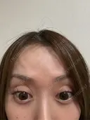 ボトックス（額） 大美会クリニック 京都烏丸院 DAY 54 サムネイル用