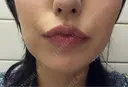ボトックス（あご） / ボトックス（エラ・小顔） / ボトックス（口角） / ボトックス（眉間） Belle Via Skin Clinic DAY 3 サムネイル用