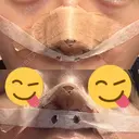 鼻尖形成（切開） / 小鼻縮小（切開） / 軟骨移植 ASTRA BEAUTY CLINIC DAY 16 サムネイル用