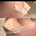 鼻尖形成（切開） / 小鼻縮小（切開） / 軟骨移植 ASTRA BEAUTY CLINIC DAY 16 サムネイル用