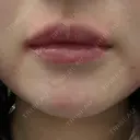 ボトックス（口角） / ボトックス（人中） DMTC CLINIC 日本橋院 DAY 0 サムネイル用