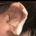 鼻尖形成（切開） / 小鼻縮小（切開） / 軟骨移植 ASTRA BEAUTY CLINIC DAY 16 サムネイル用