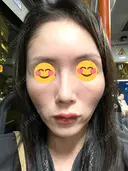 ピコレーザートーニング（美白・肝斑） シェリークリニック 渋谷院 DAY 6 サムネイル用