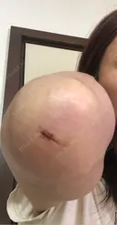 脂肪吸引（二の腕） 湘南美容クリニック 高崎院 DAY 4 サムネイル用