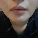 ボトックス（口角） / ボトックス（人中） DMTC CLINIC 日本橋院 DAY 1 サムネイル用