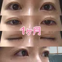 眼瞼下垂（切開） / 上まぶたの脂肪取り 白山クリニック 大分 DAY 30 サムネイル用