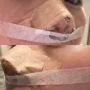 鼻尖形成（切開） / 小鼻縮小（切開） / 軟骨移植 ASTRA BEAUTY CLINIC DAY 17 サムネイル用