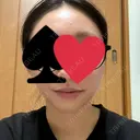 ハイフ（顔） 東京美容外科 池袋院 AFTER サムネイル用