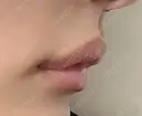 ヒアルロン酸注入（唇） / ボトックス（人中） THE FIRST CLINIC 町田院 DAY 1 サムネイル用