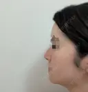 鼻尖縮小 / ヒアルロン酸注入（鼻） 東京ヒルズクリニック 銀座院 DAY 14 サムネイル用