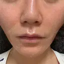 糸リフト Wing clinic 豊中駅前院 AFTER サムネイル用