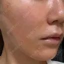 糸リフト Wing clinic 豊中駅前院 DAY 1 サムネイル用