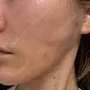 糸リフト Wing clinic 豊中駅前院 DAY 1 サムネイル用