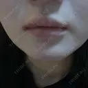 ボトックス（口角） / ボトックス（人中） DMTC CLINIC 日本橋院 DAY 2 サムネイル用