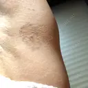 脂肪吸引（二の腕） / 脂肪溶解注射（二の腕） THE SKINNY CLINIC（ザ・スキニークリニック） DAY 7 サムネイル用