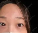 二重埋没 / 上まぶたの脂肪取り 9BeautyClinic AFTER サムネイル用