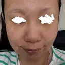 下まぶたたるみ取り アネシス美容クリニック DAY 0 サムネイル用