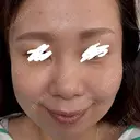 下まぶたたるみ取り アネシス美容クリニック AFTER サムネイル用