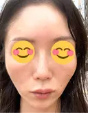 ピコレーザートーニング（美白・肝斑） シェリークリニック 渋谷院 DAY 8 サムネイル用