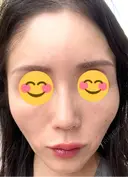 ピコレーザートーニング（美白・肝斑） シェリークリニック 渋谷院 DAY 9 サムネイル用