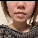 ベビーコラーゲン / RF（高周波）たるみ治療 TUNE CLINIC【チューンクリニック】 AFTER サムネイル用