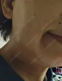 脂肪吸引（顔） 湘南美容クリニック 松戸院 DAY 1 サムネイル用