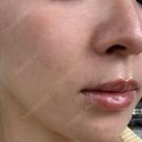 ボトックス（眉間） / ボトックス（額） / ヒアルロン酸注入（鼻翼基部） FIG CLINIC DAY 0 サムネイル用