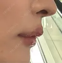 ヒアルロン酸注入（唇） / ボトックス（人中） THE FIRST CLINIC 町田院 AFTER サムネイル用