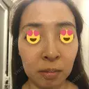 水光注射（ハリ・美肌） / ハイフ（顔） シロアム韓方美容・ダイエットクリニック(美&EYE) DAY 18 サムネイル用