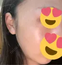 光治療（フォトフェイシャルなど） トラスト美容クリニック 銀座院 AFTER サムネイル用